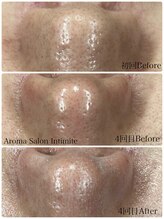 アンティミテ(Intimite)/毛穴洗浄4回の変化