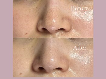 ティーツリー 名古屋 桜山(Tea Tree)/【毛穴ケア・毛穴洗浄】毛穴シミ