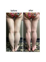 チュラ/ハイパーナイフ/所沢/痩身エステ