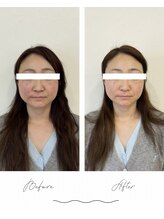マヴィ(mavie)/美顔コースBeforeAfter