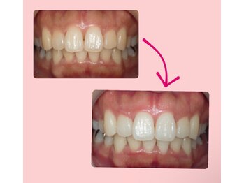 エクシアホワイトニング 武蔵小杉店/ビフォーアフター