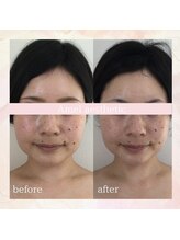 アメル エスティック(Amel esthetic)/水光ピーリング