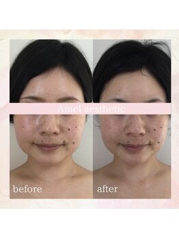 アメル エスティック(Amel esthetic)/水光ピーリング