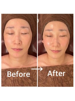 ソウ 新宿(SOU)/LAESSE新ハーブピーリング☆