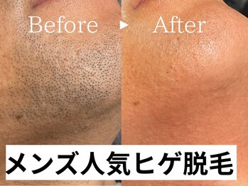 ラピスダズル(LAPIS DAZZLE)の写真/ひげ脱毛気になってるけど踏み出せない方へ!手軽に新しい自分へ変わるチャンス♪リピ率90%以上の信頼と実績