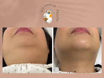 ページミュー/小顔メニュー