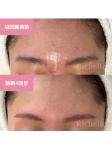 リシェル(Richelle)/ 【GREENPEELポアーズ】