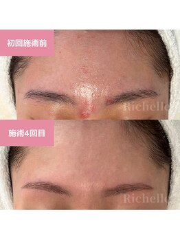 リシェル(Richelle)/ 【GREENPEELポアーズ】