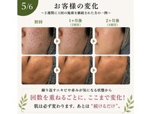 エステサロン ソワンの雰囲気（お肌のターンオーバーを早めて根本改善を目指しましょう！）