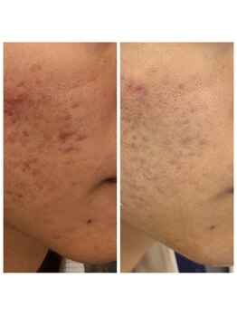 ビハダ(BeHADA)/毛穴/ニキビケア