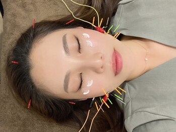 了鍼灸整骨院の写真/【月～日営業】リフトアップ小顔鍼灸¥3300・シミしわや肌質にアプローチ！肌代謝UP美容鍼¥3300～