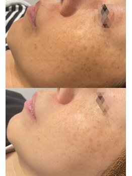 モルセラ(Moluccella)/3回の施術