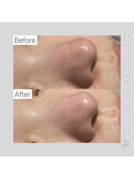 ホワイトラボ 姫路(White labo)/毛穴のお掃除！大人気毛穴洗浄☆