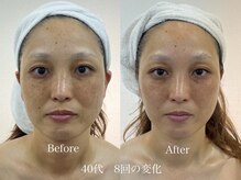 グランディールスイート(GRANDIR suite)/FACE MAKER施術結果