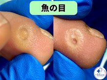 プラスワンフット 本厚木(+1 Foot)/タコ・魚の目ケア！痛みから解放