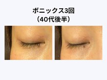 アユアラングレース/40歳後半・3回/目元のシワ消失！
