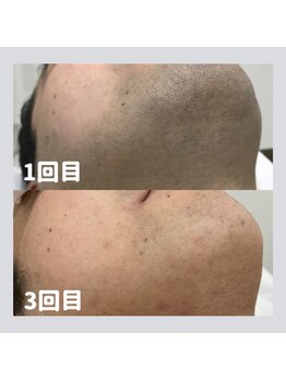 アイル(I'll)/ヒゲ脱毛で清潔感アップ