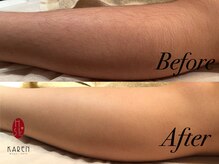 カレン 鹿児島中央駅店/ひざ下脱毛