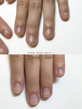 マリーロール 梅田店(Marie Laure)/自爪育成/深爪矯正/ネイルケア