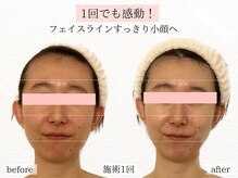 小顔はお任せ下さい◇筋膜リリース小顔フェイシャル施術1回