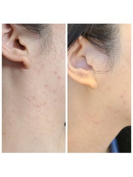 ビハダ(BeHADA)/ニキビケア/シミしわ改善