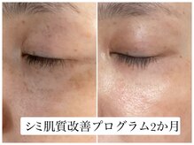 ヌー 栄(nuu)/シミ肌質改善プログラム2か月