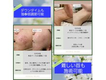 サロンド ベレーゼの雰囲気（三回のご来店でお顔だけでなく首、二の腕、背中夏の露出に対応）