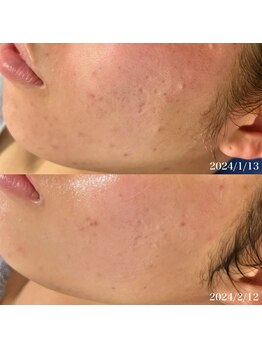 リリアス(RILLIAS)/肌トラブル跡ケア