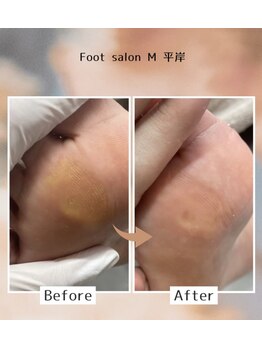 【魚の目/タコ】30代女性