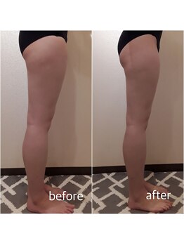 クリニカルエステ/イーズ パークプレイス大分店/【レモンボトル】下半身太り解消