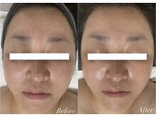 ルーナ 恵比寿(Luna)の雰囲気（強力なRFでこりを取ってたるみほうれい線リフトUP肌質まで良好に）