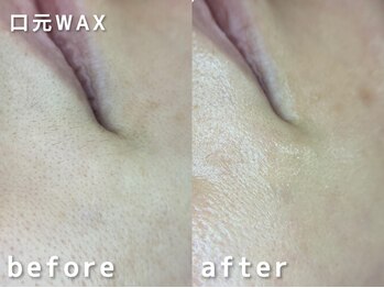 サルレ(Sarule)/口周り産毛ワックス脱毛