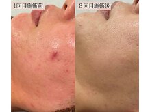 リノン(LINON)/ハーブピーリング 施術回数８回