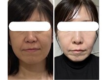 スリーメイ(3mey)の雰囲気（強力高周波美容医認可マシンで本気のたるみケア。）