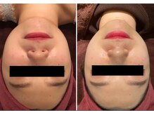 ルナグランデ(Luna grande.)/顎周りスッキリ！