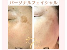 コトハ(cottha)の雰囲気（60代女性/8回施術後　シミ改善【フォトギャラリ―参考】）