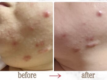 ナチュラーレ 京都四条烏丸店(Naturale)/美肌ニキビケア小顔フェイシャル