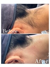 ピュア 川越店/うなじ脱毛