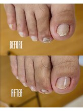 おん/巻き爪補正なしケア