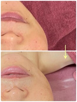 リファイン(REFINE)/赤ら顔や色むらが改善・・