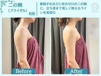 フローフシ∞/【痩身/たるみ】ブライダル痩身