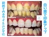 【迷ったらコレ！白い歯で印象UP】初めてのセルフホワイトニング(限定5名/日)