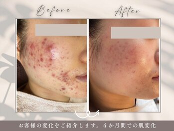 碧(ao)/肌質改善・ニキビ肌荒れ