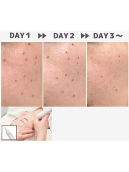 マヴィ 守口店(MavY.)/シミケア人気です！