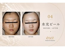 エテル(eter)/水光ピール　before after