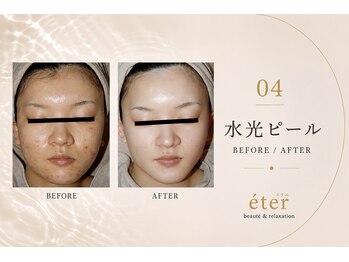 エテル(eter)/水光ピール before after