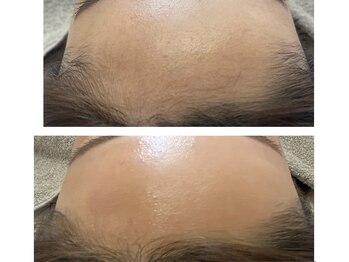 モワメーム(moi meme)/フェイシャルワックスでツルツル