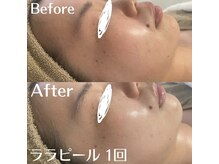 ホワイトアクア 中目黒店(WHITE AQUA)/ララピール・水光肌