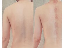 サプナジー(Suppnrgy)/カスタムトリートメント