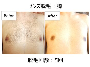オワゾーブルー(Oiseaubleu)/【メンズ】胸脱毛5回目